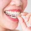 aligneur transparent pour orthodontie invisible du  Cabinet d'orthodontie à Chalon-sur-Saône, 