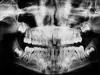 radio panoramique de la dentition lors d'un bilan orthodontique à chalon-sur-saône