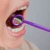 fil de contention orthodontique collé sur l'arcade dentaire inférieure