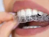 femme en traitement orthodontique adulte plaçant sa gouttière dentaire