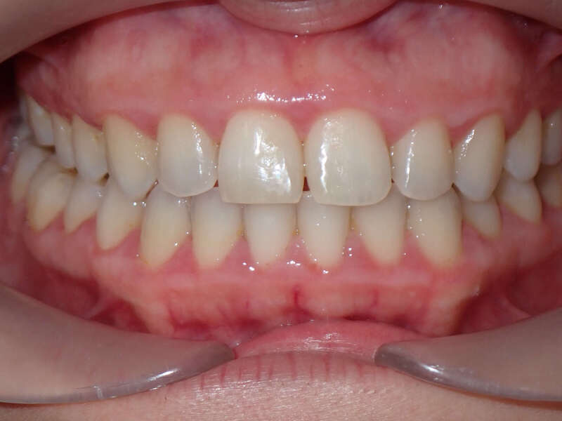Avant-après d’un traitement d’orthodontie adulte réalisé en 16 mois avec nos aligneurs transparents REALINIUM.