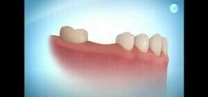 Ancrage osseux : miniplaque de Bollard