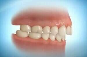 Distalisation molaire avec une minivis