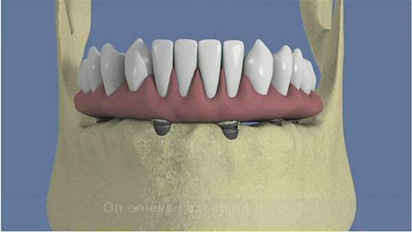 Mandibule complète et traitement implantaire pour un bridge fixe vissé
