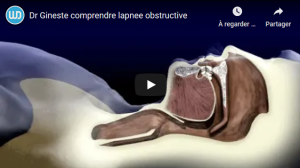 Comprendre l'apnée obstructive