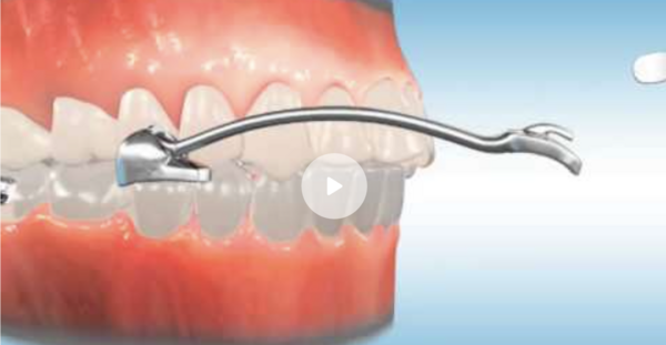 Carriere Motion Vidéo