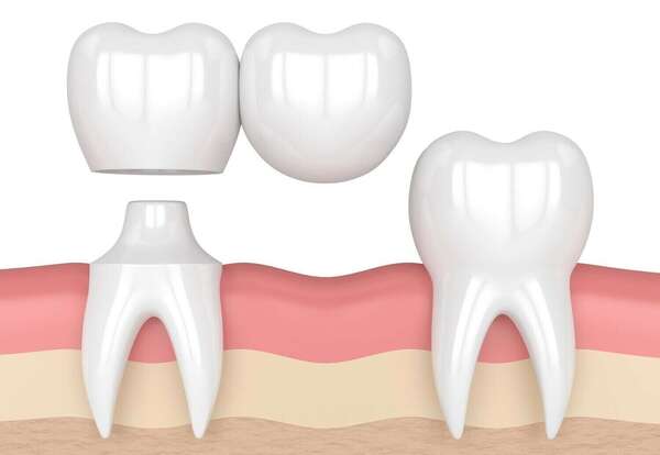 Bridge cantilever et bridge collé