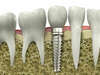 Implant dentaire et implantologie