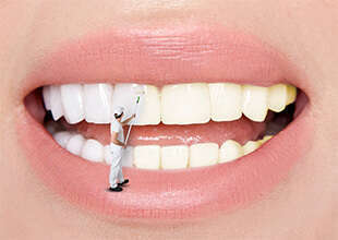 LE BLANCHIMENT DES DENTS