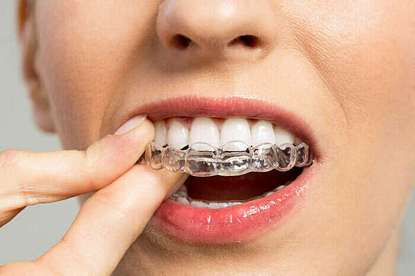 LA TECHNIQUE INVISALIGN® – ALIGN TECHNOLOGY