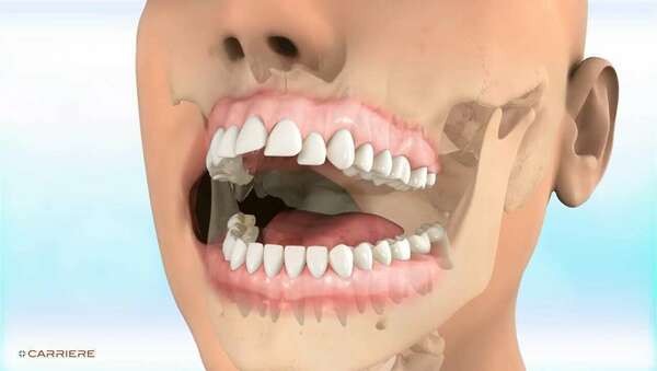 Carriere motion classe ii