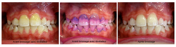 OPTEZ POUR LE REVELATEUR DE PLAQUE DENTAIRE !