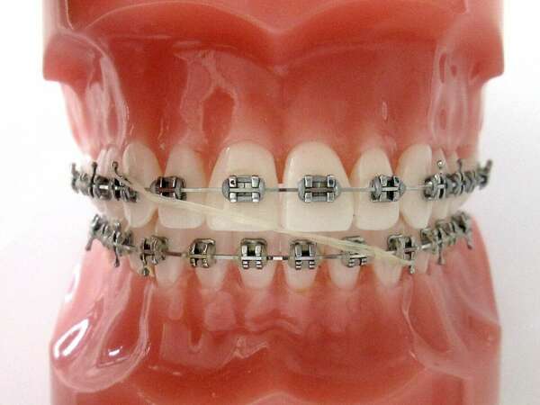 CORRECTION D'UNE DEVIATION DES MILIEUX PAR ELASTIQUES