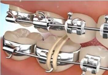 CORRECTION D'UN INVERSE D'ARTICULE PAR ELASTIQUES