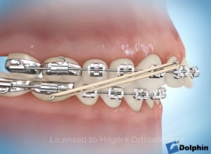Les élastiques en orthodontie - Class II