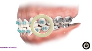 Élastiques de classe III