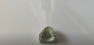 Que faire si un appareil fixe au palais se détache ?