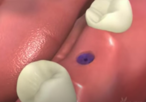 Couronne sur implant dentaire