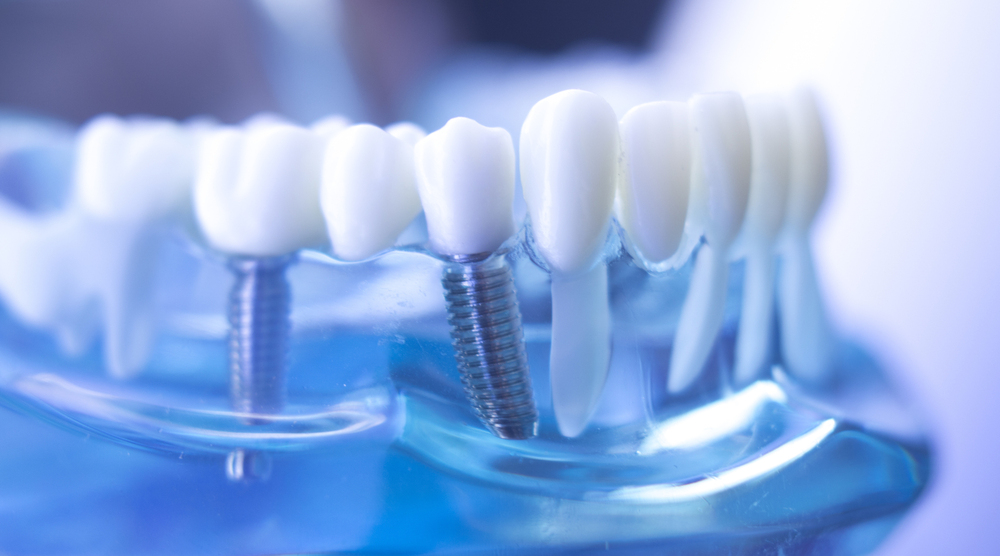 L’implantologie dentaire : une solution moderne pour remplacer les dents manquantes par le Dr Remy, dentiste à Paris 7