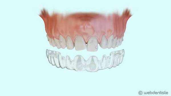 Gouttières invisibles (avec taquets)