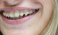 L'ORTHODONTIE