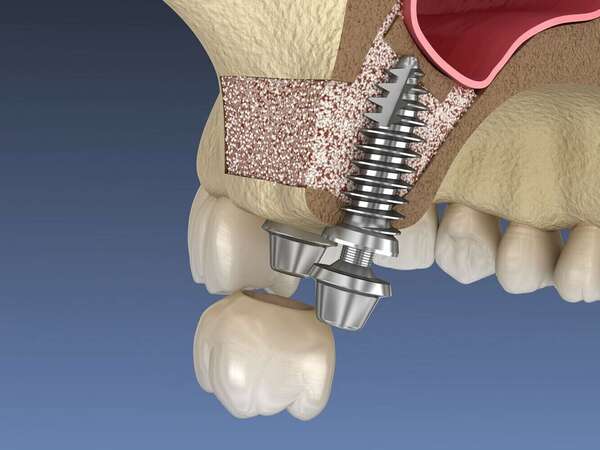 La greffe osseuse intra sinusienne ou sinus lift
