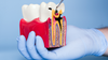 traitement des caries à Saint-Romain-de-Colbosc – Parc Éco Normandie