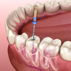 traitement endodontique à Saint-Romain-de-Colbosc – Cabinet du Parc Éco Normandie