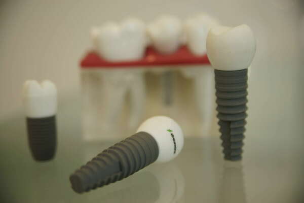 Les implants : Questions / Réponses