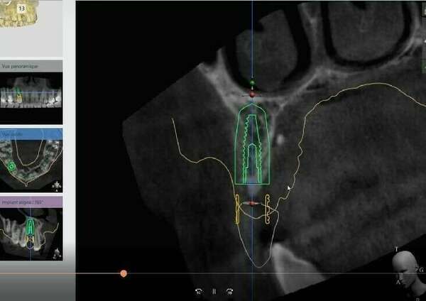 L'implantologie assistée par ordinateur
