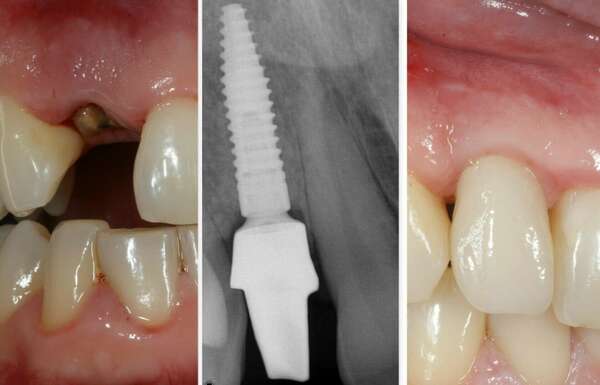 La mise en charge immédiate d’une prothèse sur un implant