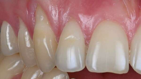 Microchirurgie des gencives