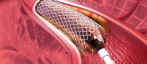 L'Alliance Bénéfique de la Sophrologie et de la Reprise d'Activités Physiques Après la Pose d'un Stent