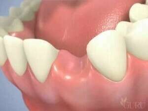 pose d'un implant dentaire en 2 temps avec un pilier titane