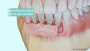 Greffe gingivale libre la technique de l’autogreffe