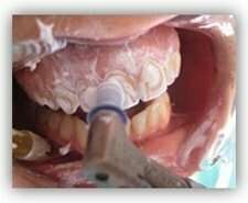 Prévention et soin des caries par la prophylaxie individuelle