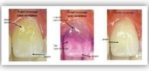 Qu’est-ce que la plaque dentaire ?