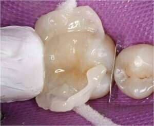 Cas clinique : Dentisterie Adhésive / Dentisterie Esthétique