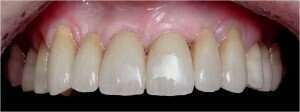 Cas clinique : Prothèse fixée conventionnelle : Couronnes et bridges