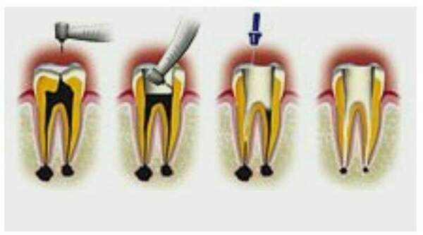 Comment soigner la carie ?
