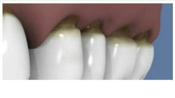 Qu’est ce qu’une myolyse ?