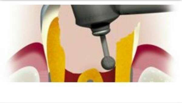 Qu’est ce que la pulpotomie ?