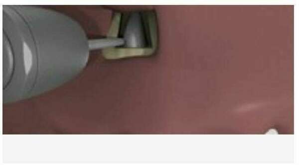 La résection apicale