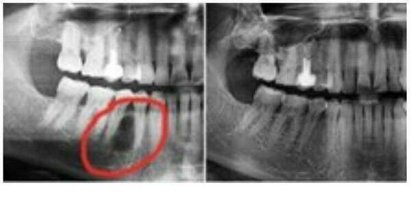 Qu’est ce qu’un granulome ou un kyste dentaire ?