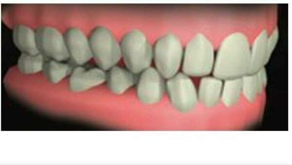 Les pathologies de l'occlusion