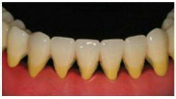 Mes dents bougent que faire ?