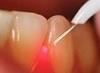 Laser dentaire pour soins précis et confort patient