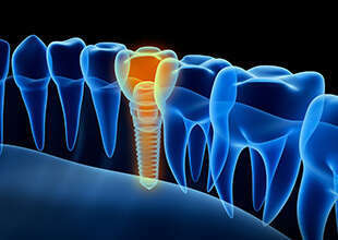 POSE D'IMPLANTS DENTAIRES