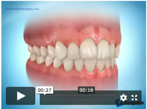 Bagues auto-ligaturantes