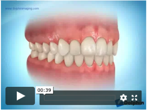 Alignement par gouttières esthétiques